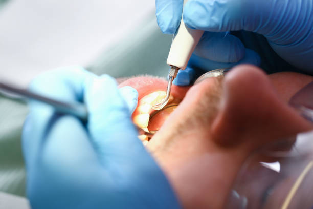 Best Knocked-Out Tooth (Avulsed Tooth) Treatment in Laguna Beach, CA