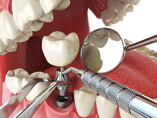 Best Broken or Chipped Tooth Repair in Laguna Beach, CA